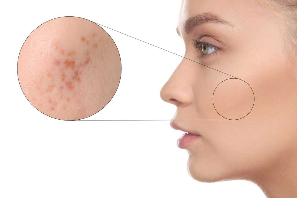 ACNE: CAUSES, TYPES AND TREATMENT