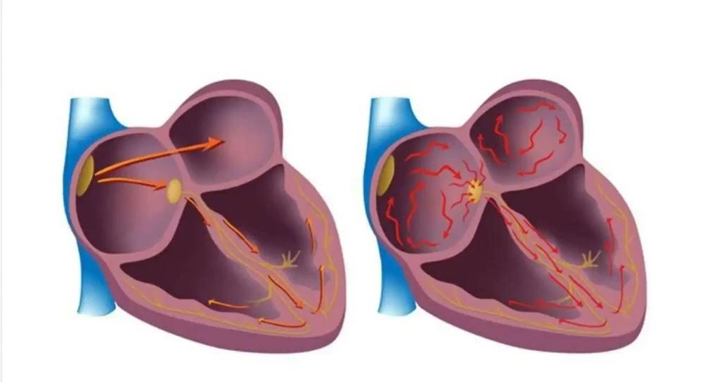 ARRITHMIA AND ATRIAL FIBRILLATION