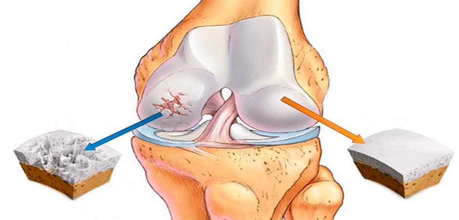 DEFORMING OSTEOARTHRITIS