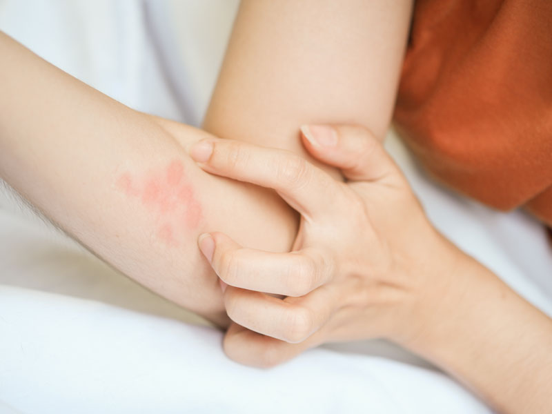 ATOPIC DERMATITIS (ECZEMA)