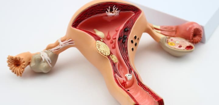 ENDOMETRIAL POLYP: DIAGNOSIS AND TREATMENT IN ARMENIA