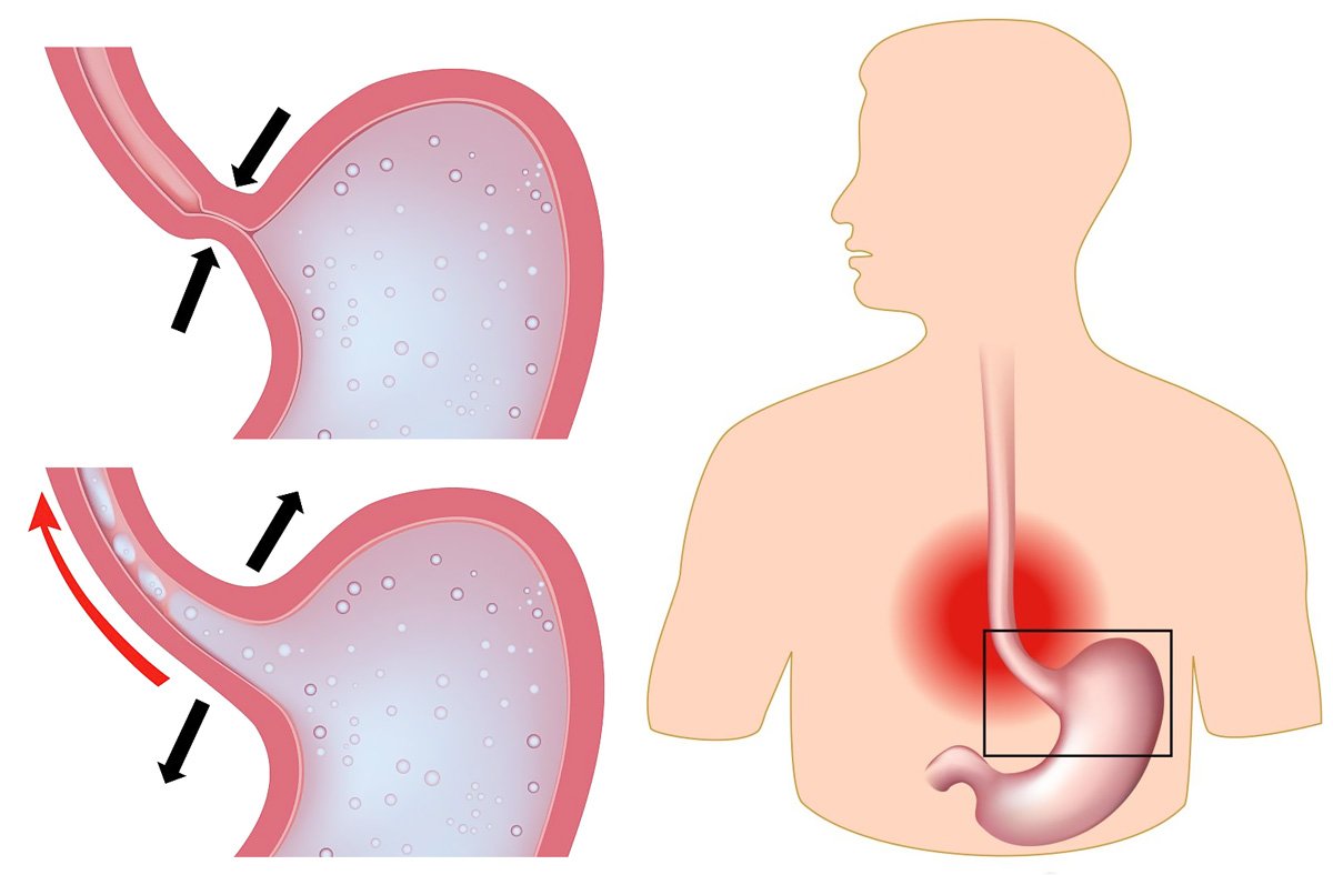 GASTROESOPHAGEAL REFLUX DISEASE (GERD)