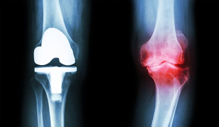 РЕНТГЕН КОЛЕННОГО СУСТАВА В АРМЕНИИ