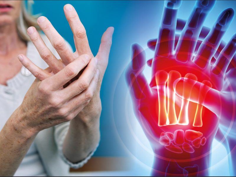 REUMATOID ARTHRITIS: DIAGNOSIS AND TREATMENT