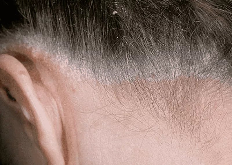 SEBORRHEIC DERMATITIS