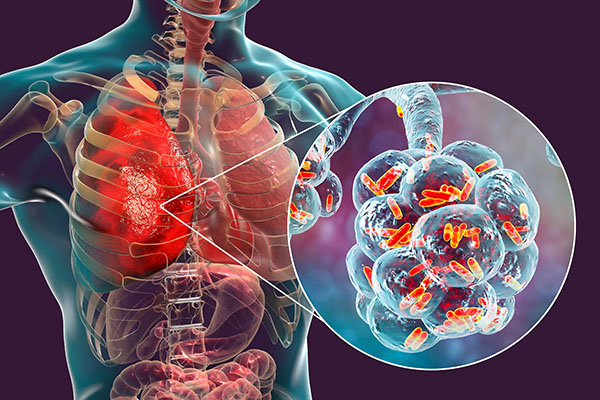 COMMUNITY-ACQUIRED PNEUMONIA (CAP)
